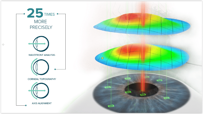 iDesign® Wavefront Laser Vision Correction 1 iDesign® Wavefront Laser Vision Correction