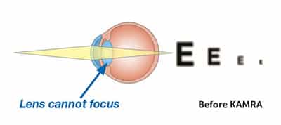 eye-diagram-presbyopia Common Vision Questions